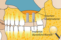 Sinuslift-Knochenaufbau