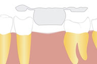 Brückenbehandlung