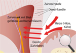 Schmerzempfindliche Zähne Schmerzempfindliche Zähne