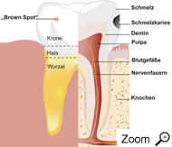 Karies in Schmelz und Dentin