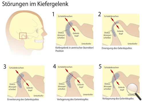 Kieferstoerungen