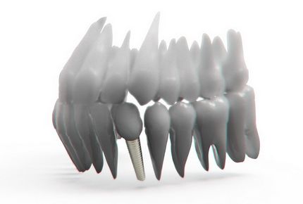 implantate 3d planung